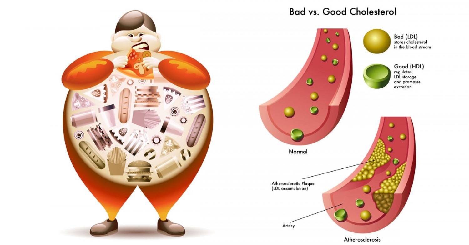  Egy kutatóorvos leleplező irása szerint nincs rossz koleszterin! Ez bizony csak átverés!