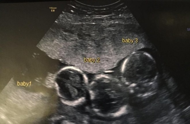 Már egy hármas iker terhesség is ritka, de amikor megszülettek az orvosoknak elállt a szava!